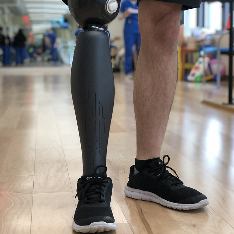 ✓ 2024 March, Above-Knee Prosthetic Legs